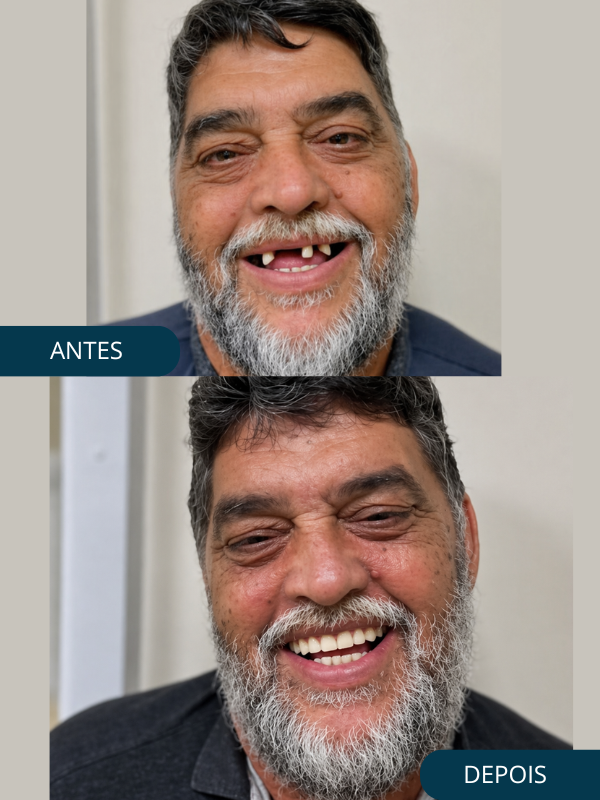 Antes - Prótese Protocolo Paciente 1